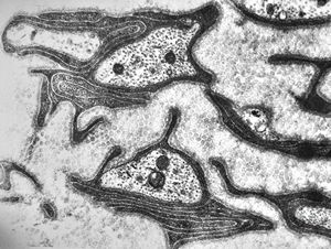 F,13y. | F,13y. | n.suralis … axonal neuropathy … Charcot-Marie-Tooth disease